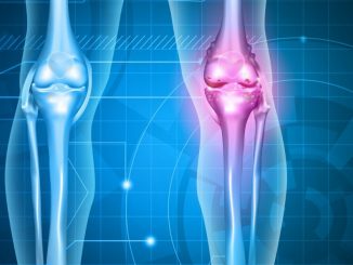 Hay una razón celular por la cual la artritis reumatoide puede diferir por ...