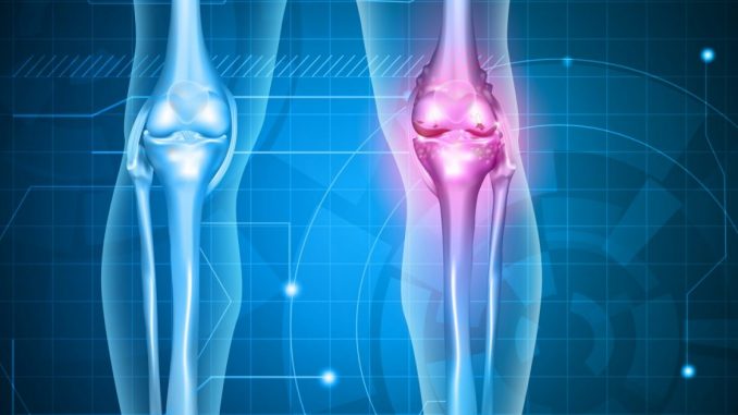 Hay una razón celular por la cual la artritis reumatoide puede diferir por ...
